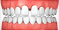 ortodonzia pediatrica: diastematura