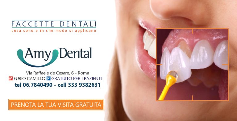 Faccette dentali a Roma