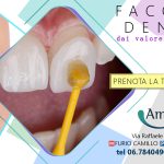 Faccette dentali: cosa sono e quanto costano